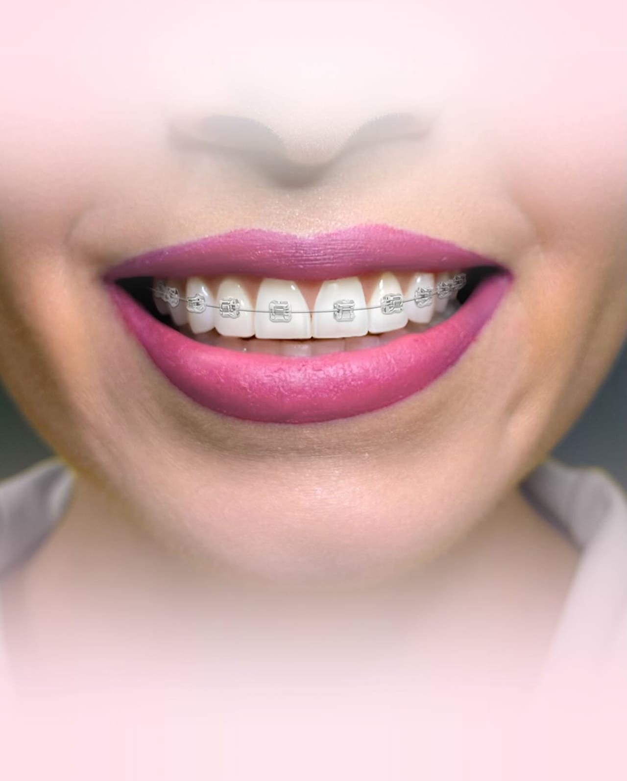 Antes y después de diseño de sonrisa en Dental Group Panama