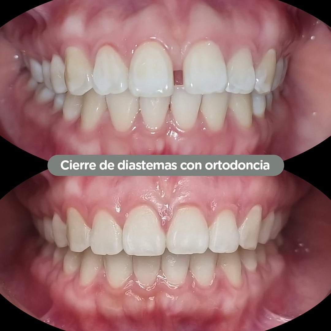 Antes y después de tratamiento de ortodoncia en Dental Group Panama