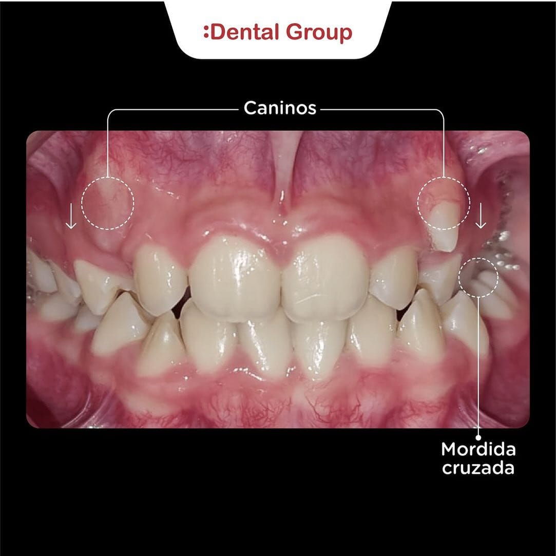 Antes y después de tratamiento de ortodoncia en Dental Group Panama