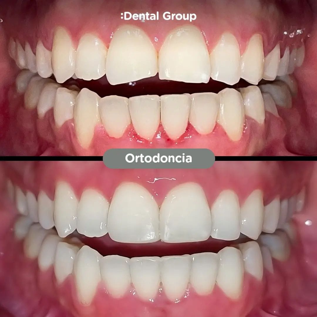Antes y después de tratamiento de ortodoncia en Dental Group Panama