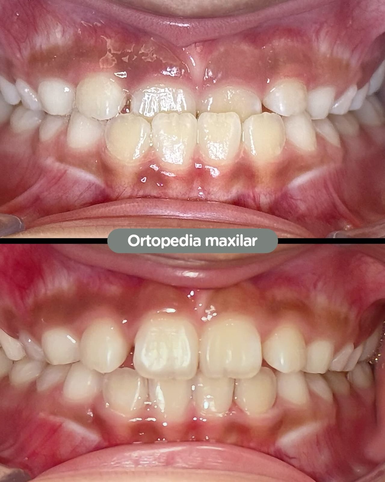 Ortopedia maxilar en paciente pediátrico